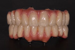 brug op implantaten